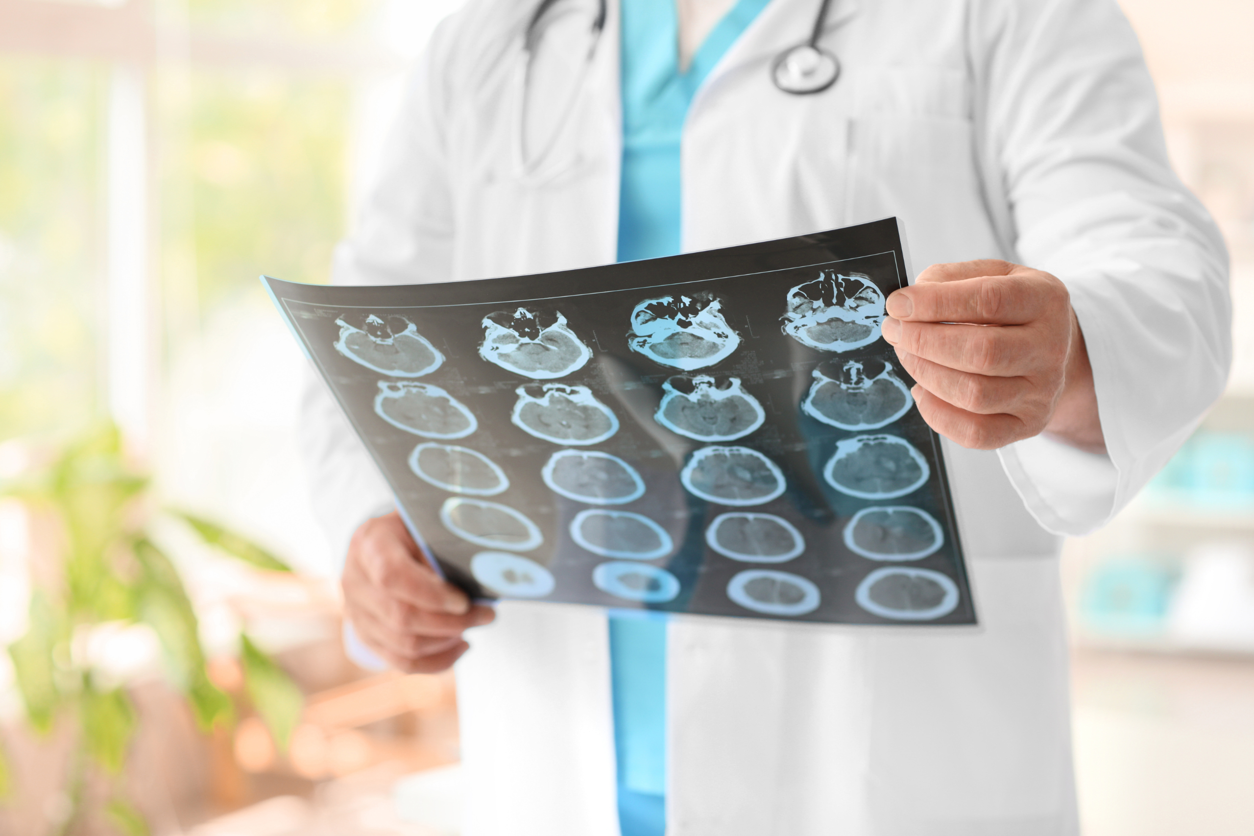 A medical professional in a white coat holding and examining a series of CT scan images, possibly reviewing a patient's brain scans for diagnosis.