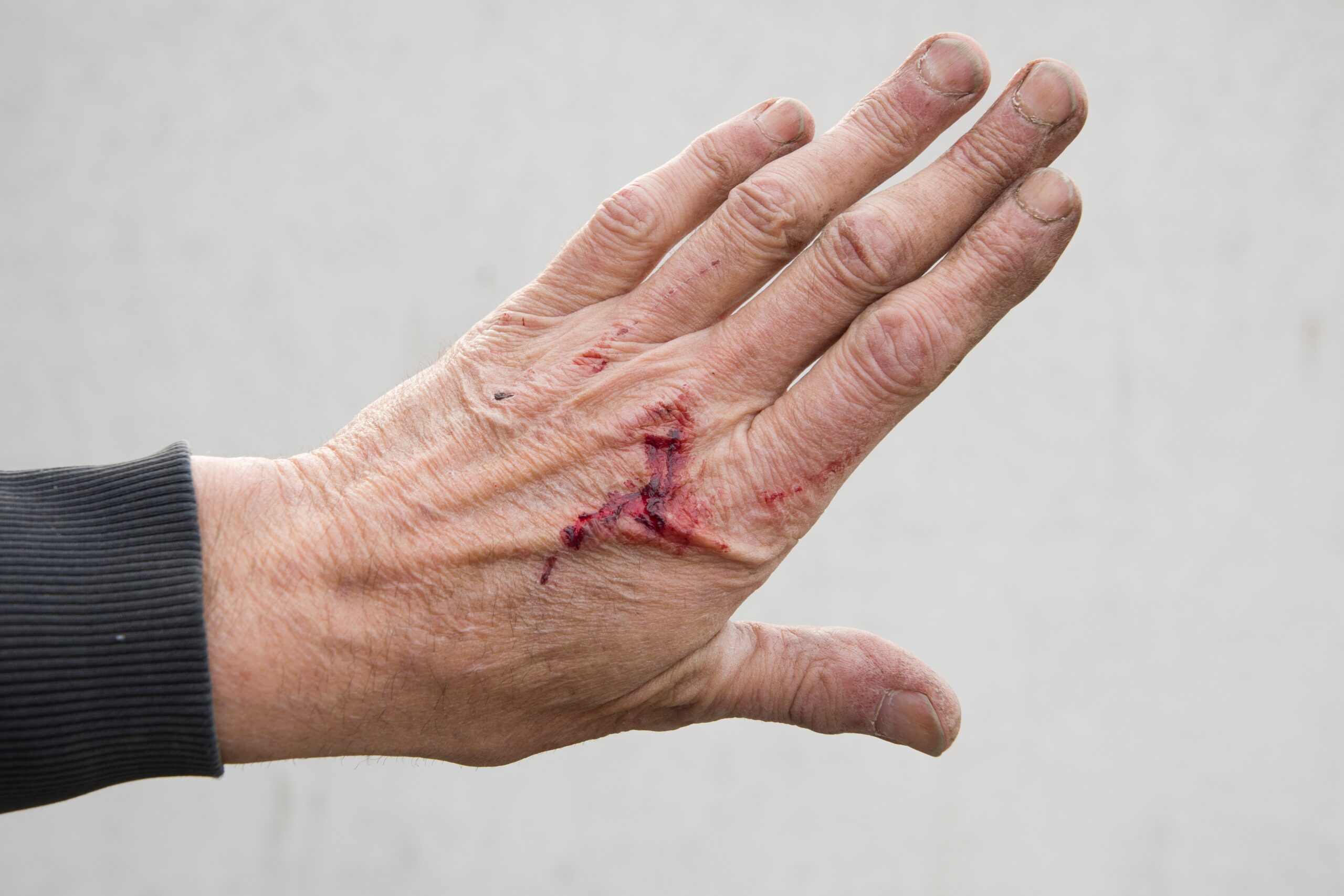Close-up of injured hand with dog bite wound, supporting WD Law personal injury and dog attack claims.