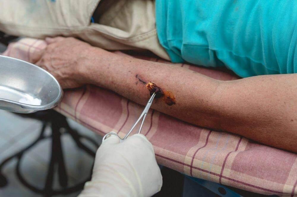 Medical attention for a dog bite